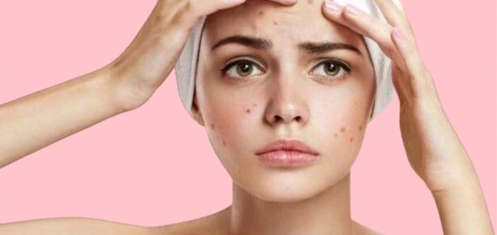 Gambar kulit berjerawat